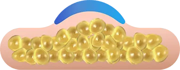 Illustration of an applicator drawing in the fat layer for CoolSculpting fat freezing in Amsterdam