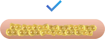 Illustration of broken fat cells absorbed by the body for CoolSculpting fat freezing in Amsterdam