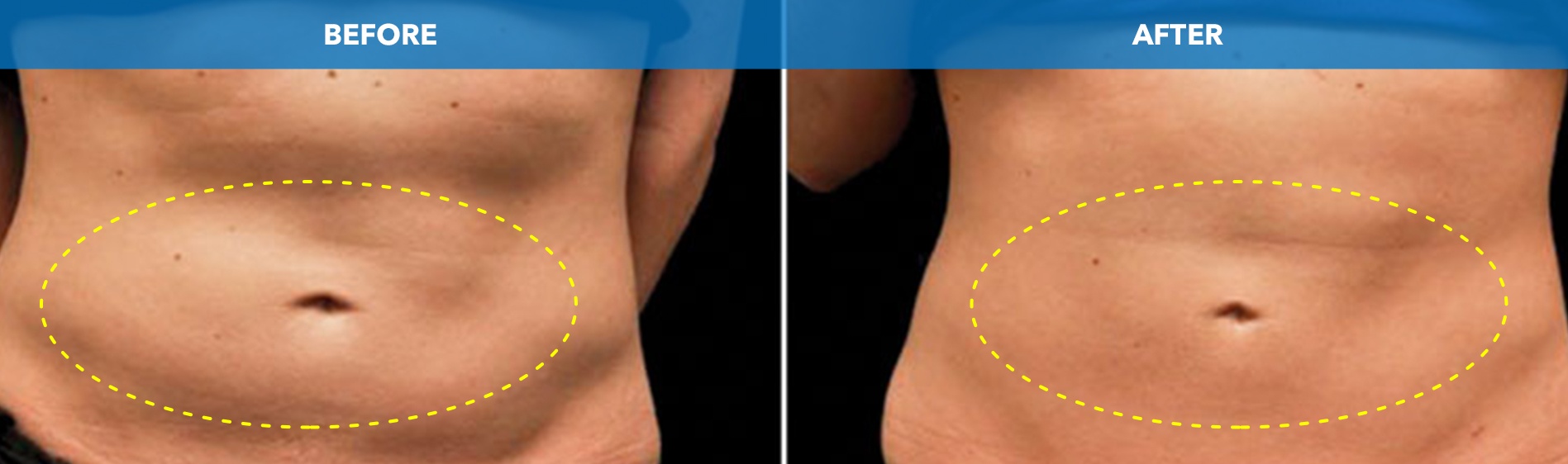Abdomen before and after CoolSculpting fat freezing at Cool Clinic in Amsterdam